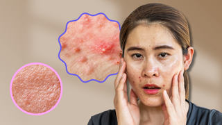 Kulit Berminyak dan Berjerawat? Ini Cara Detox Wajah yang Bisa Kamu Coba