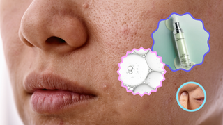 Kulit Dehidrasi: Penyebab, Ciri-Ciri, dan Cara Mengatasinya dengan Serum Hyaluronic Acid